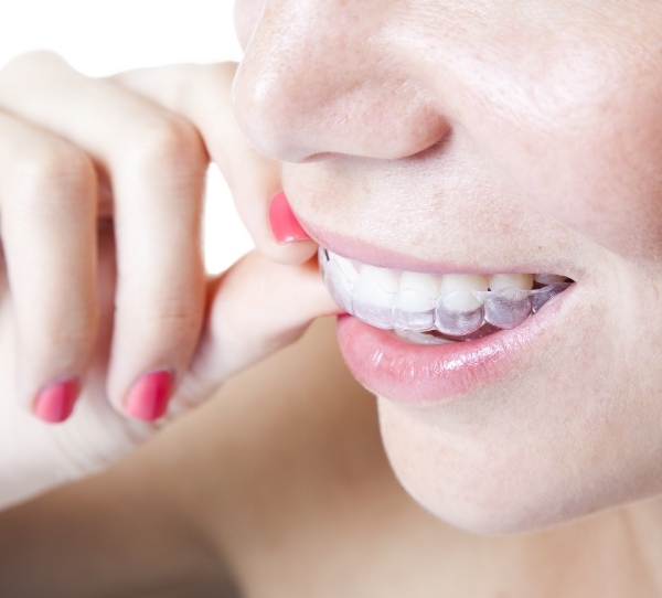 Putting on invisalign clear aligners