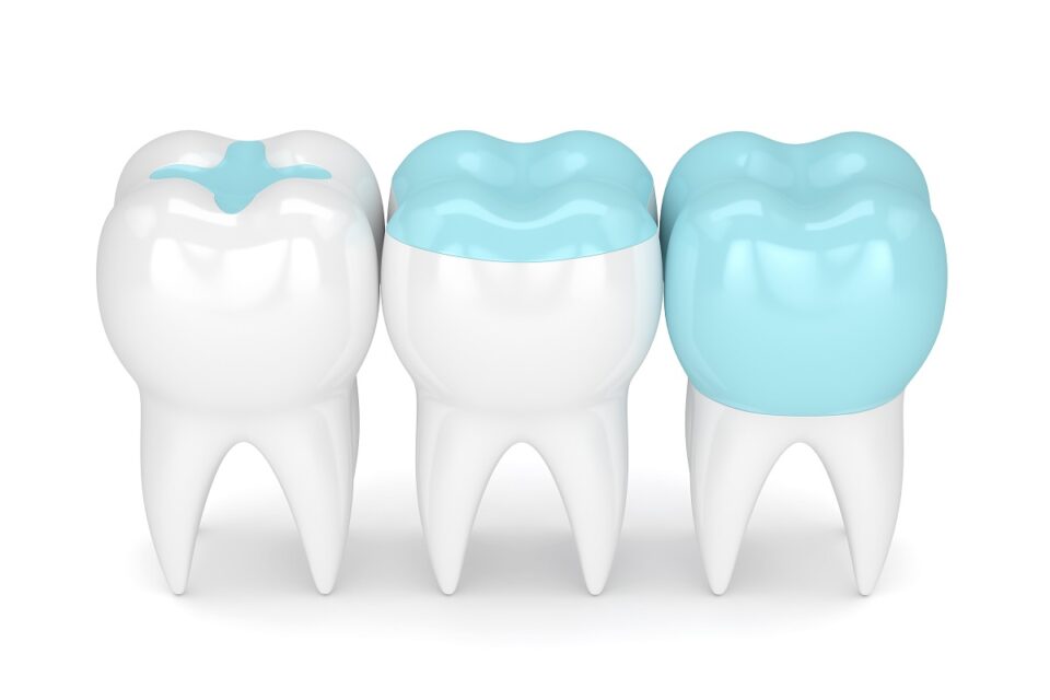 Dental Sealants at Twin Aspen Dental in Parker, CO