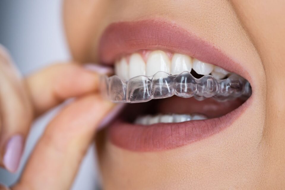 Woman putting her Invisalign on her teeth