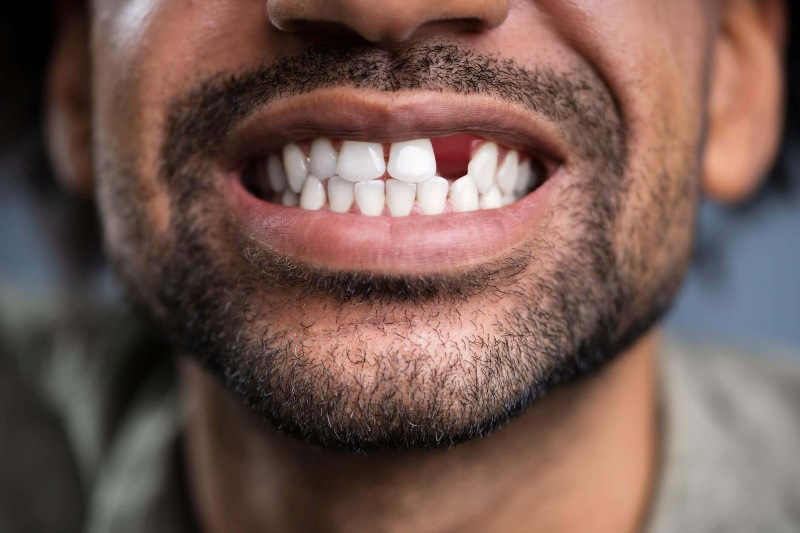 A man with a missing tooth needs a tooth replacement dental procedure from Twin Aspen Dental Centers. 
