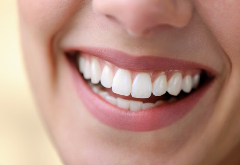 A close-up view of a woman's teeth after receiving a one-day smile makeover treatment in Parker, CO