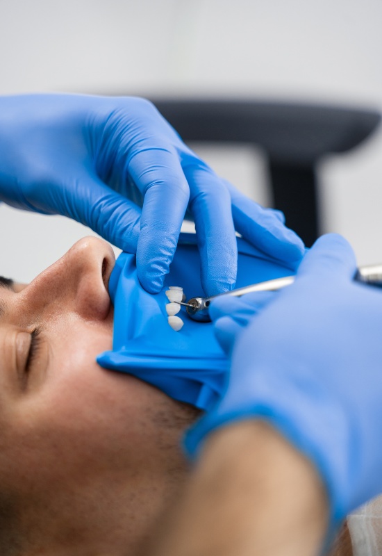 A dentist placing a same-day dental crown on a patient using specialized tools in Parker, CO