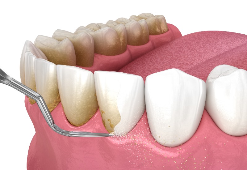 Close-up illustration of scaling & root planing procedure on teeth and gums in Parker, CO