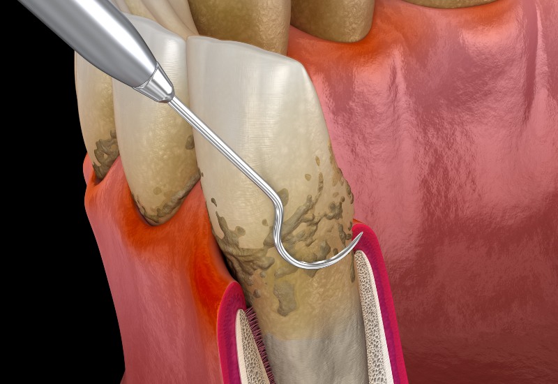Dental tool performing a scaling and root planing procedure in Parker, CO